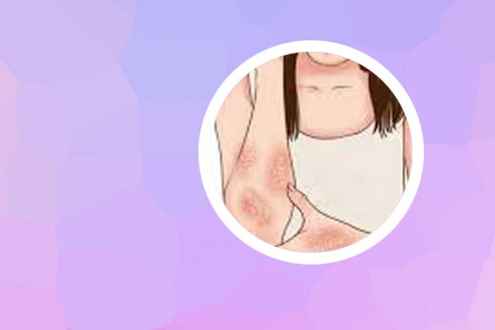 点滴状银屑病