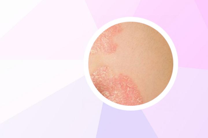 银屑病洗完澡用什么润肤