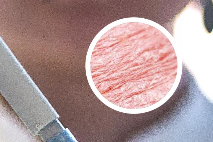 牛皮癣治疗的最佳药物