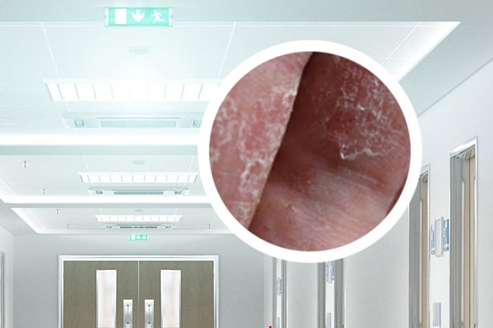 银屑病是否会被益火加重