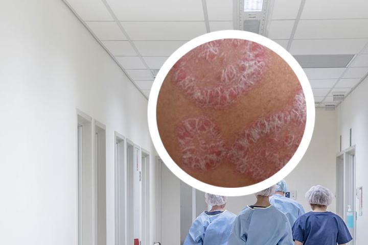 艾滋病患者银屑病