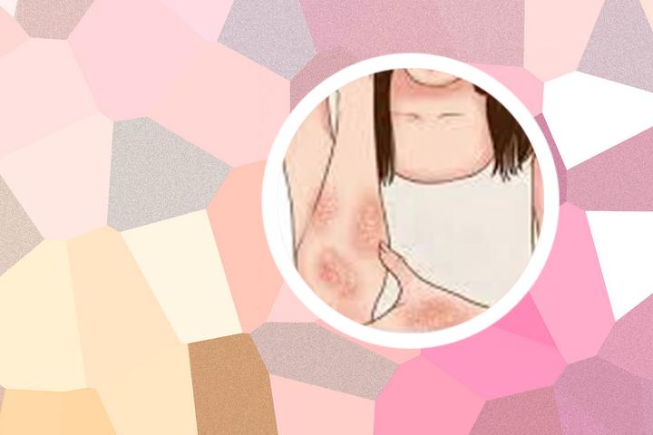 银屑病可否完全治愈