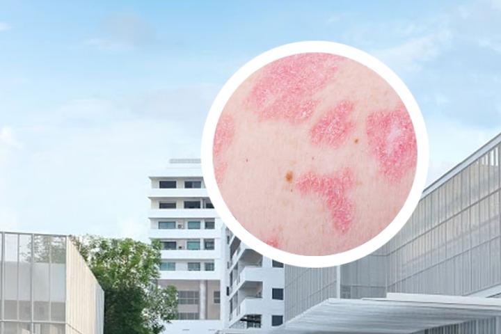 阿维a治疗点滴状银屑病
