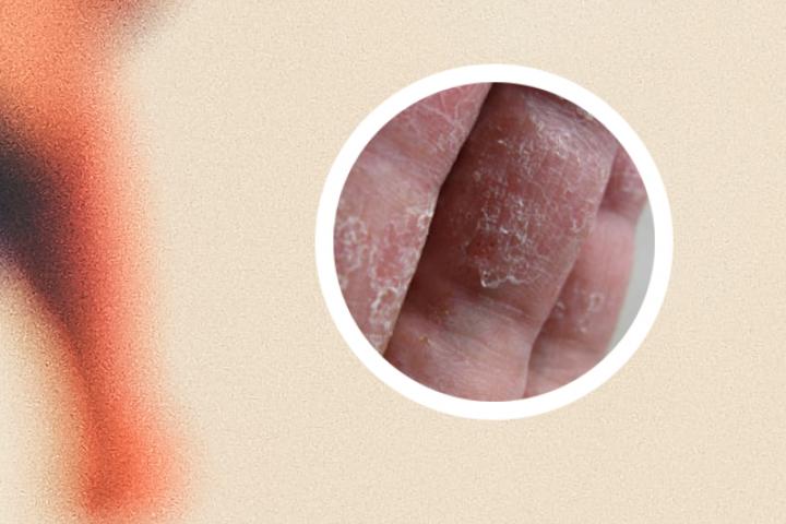 拔罐治疗银屑病方式有哪些 拔血罐银屑病治好了
