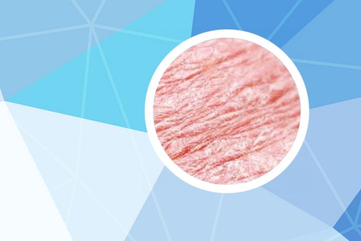 为什么晚上银屑病会更加瘙痒