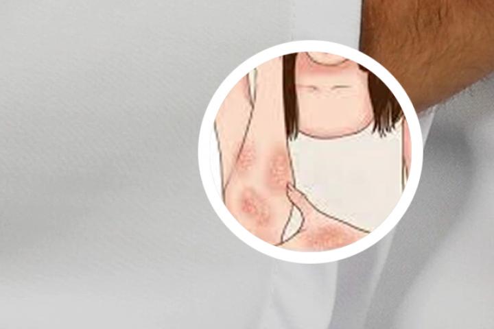 牛皮癣多喝水