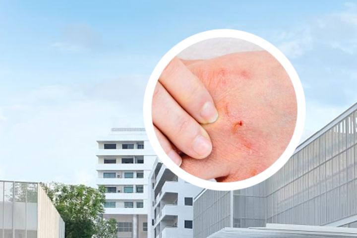 每天跑步能缓解银屑病吗