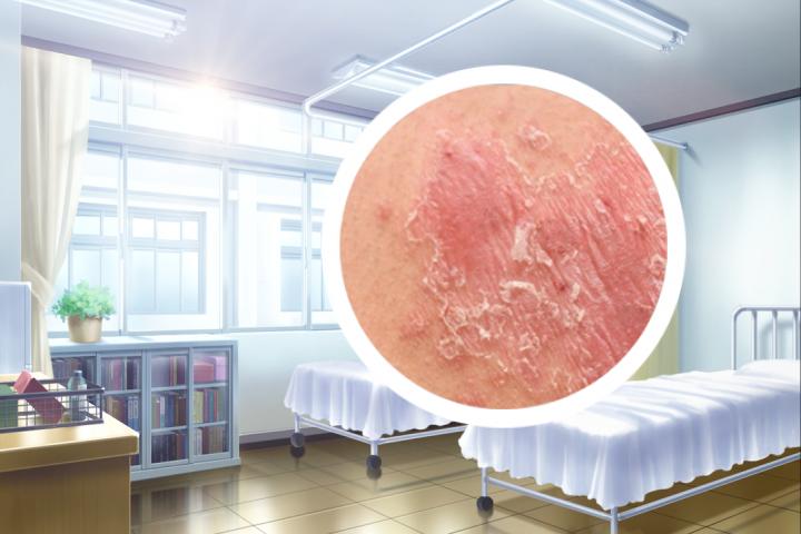 牛皮癣的克星有什么