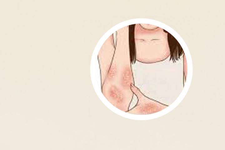 关节型银屑病和银屑病关节炎的区别