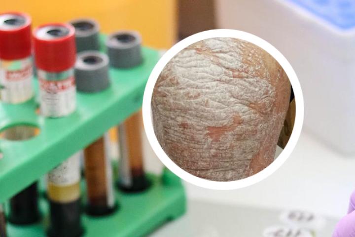 牛皮癣易感细胞