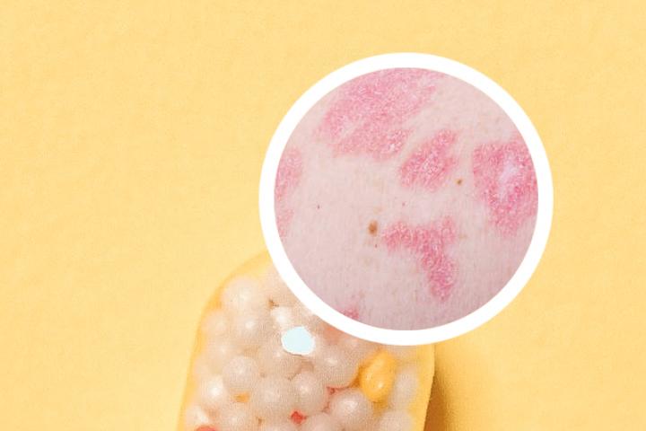 治疗银屑病用什么药膏最好