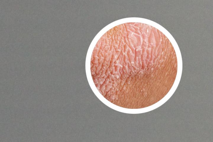 生物制剂治疗银屑病有哪些副作用呢