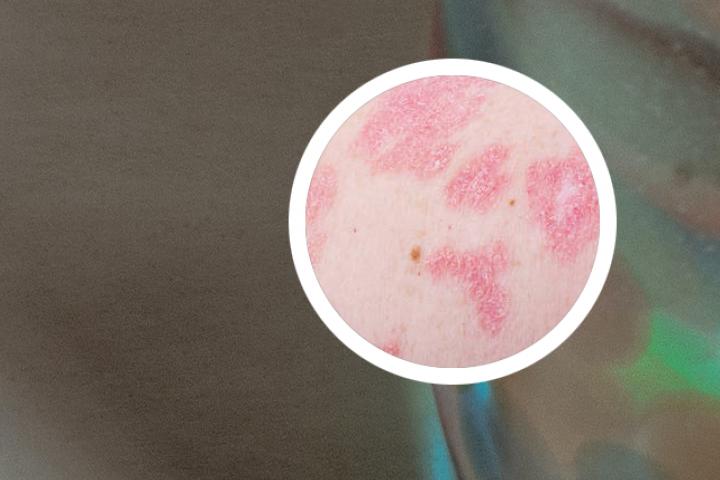 谁涂过煤焦油治银屑病