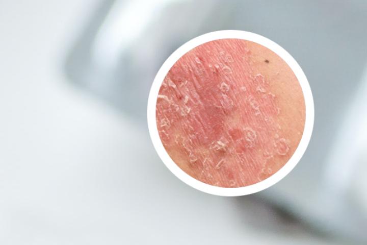 阿维a治疗银屑病使用方法