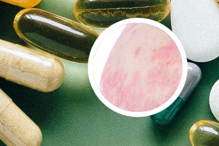 朱仁康治疗静止期牛皮癣