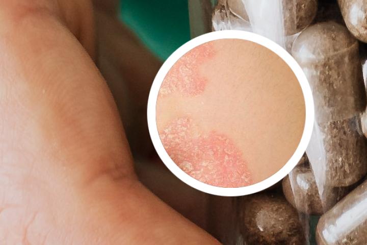 银屑病洗完澡