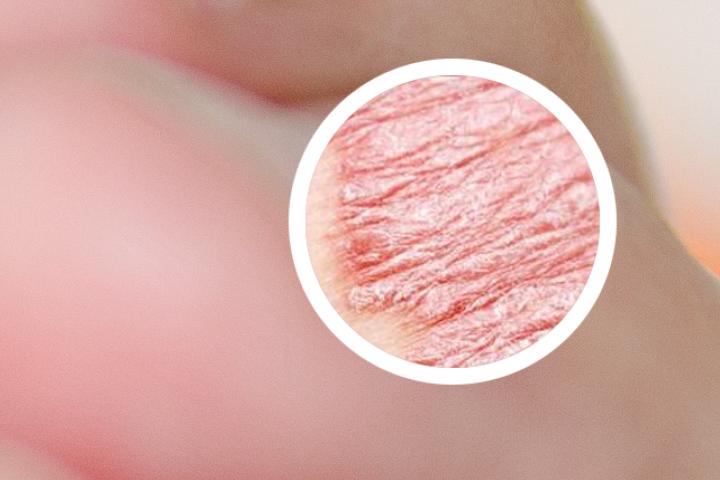 甲氨蝶呤能治疗银屑病吗