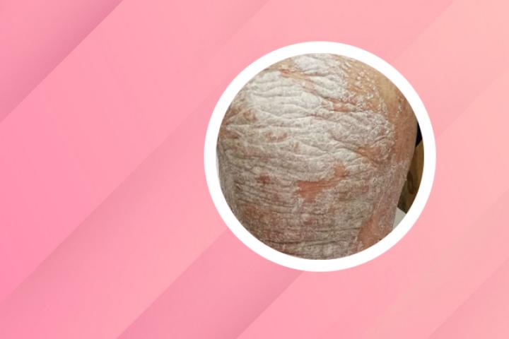 关节型银屑病和银屑病关节炎的区别