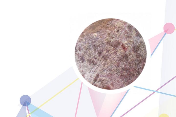 刺儿菜能否治愈银屑病