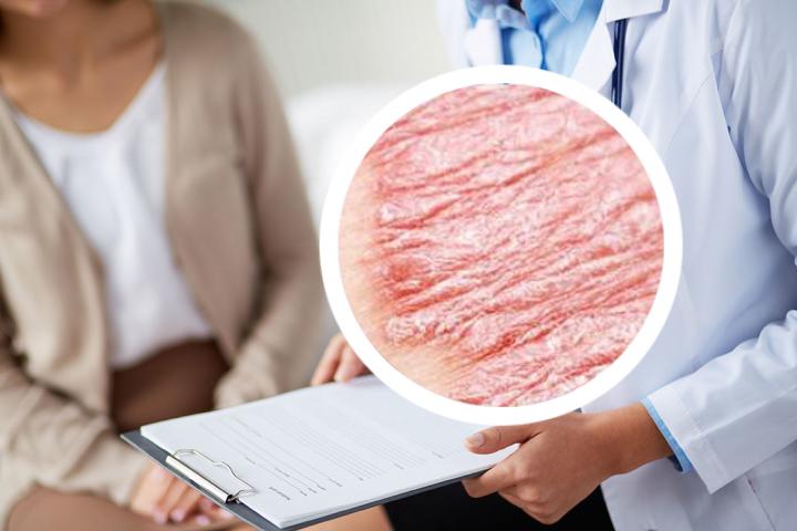 哪种医疗器械可以帮助我治疗银屑病?