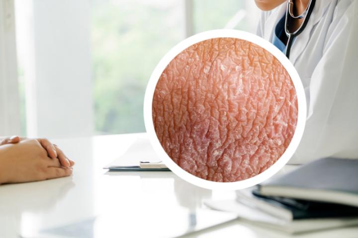 银屑病是不是蛇缠腰