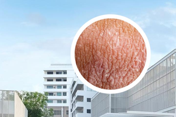 银屑病跟hiv有关系吗