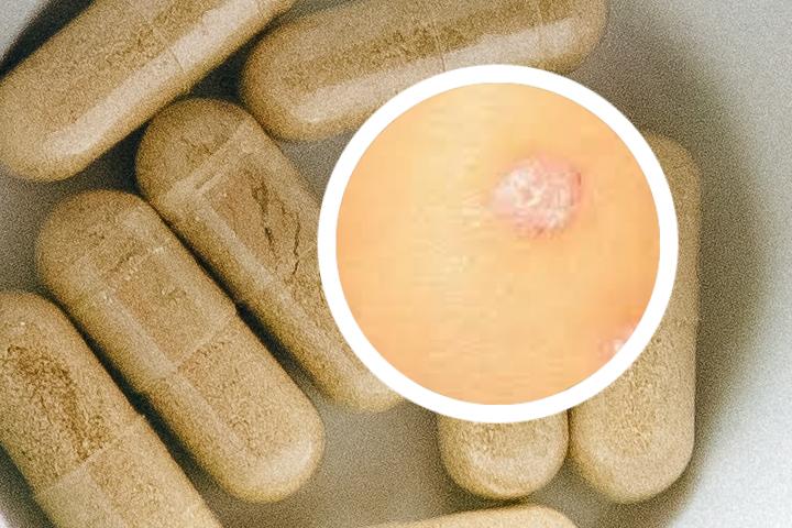 银屑病终身不复发的案例