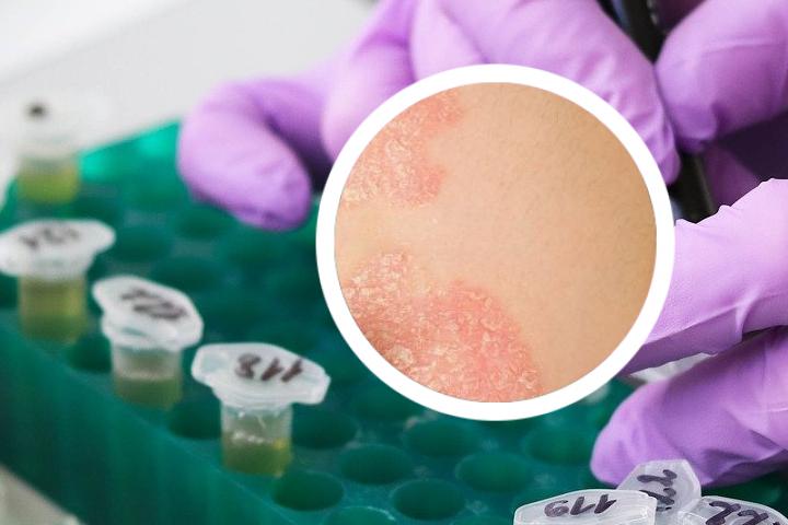 银屑病生物制剂阿达木单抗
