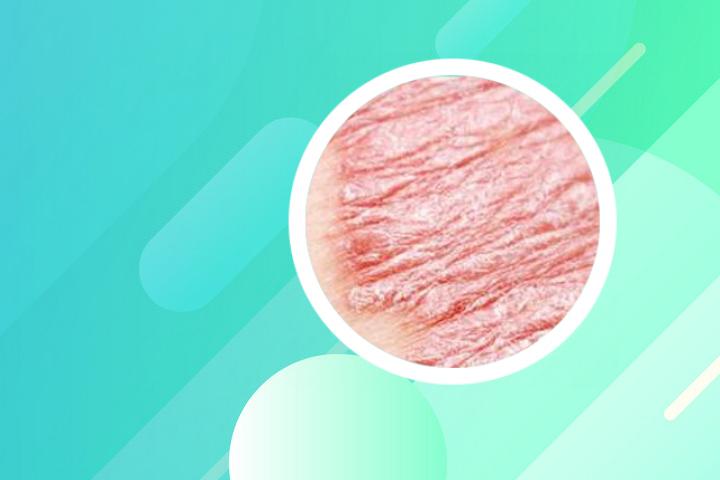 苹果小分子肽能治牛皮癣吗