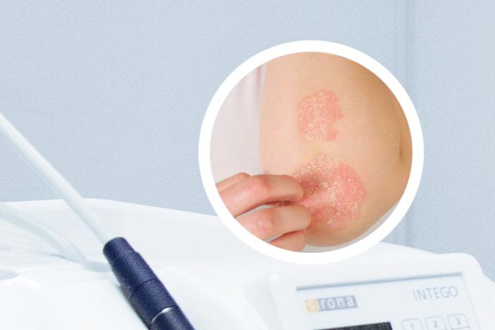 银屑病可以用弥芙康、吡硫翁，或欣治疗吗