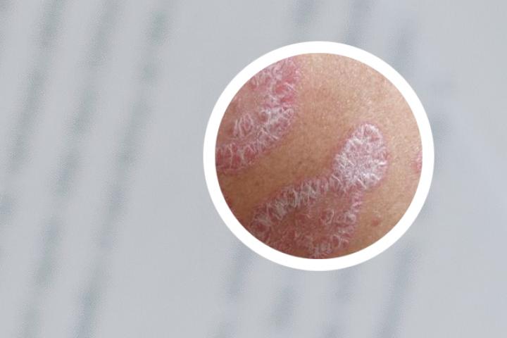 银屑病发病顺序是什么