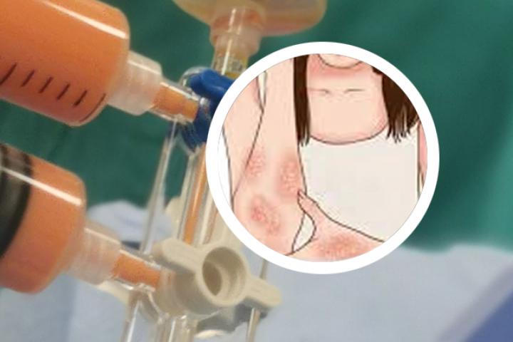 银屑病查哪个科