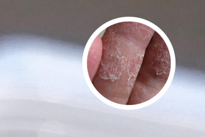 南京皮肤病研究所看银屑病怎么样