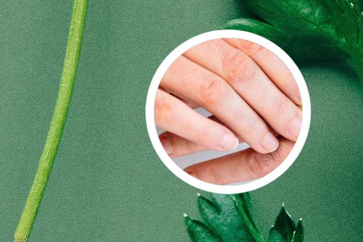 副银屑病能治好吗儿童