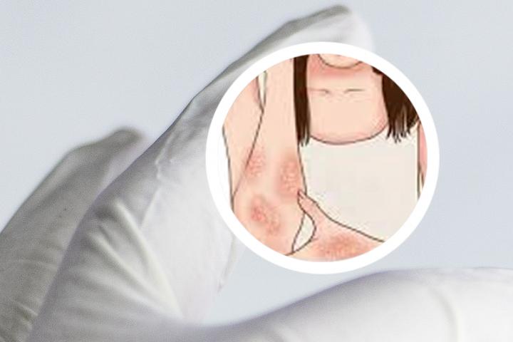修美乐几针能治愈银屑病