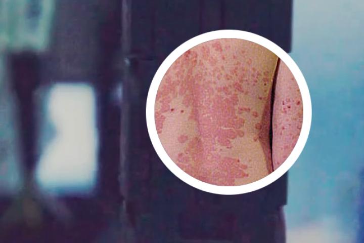 根据银屑病的临床和病理特征可分为