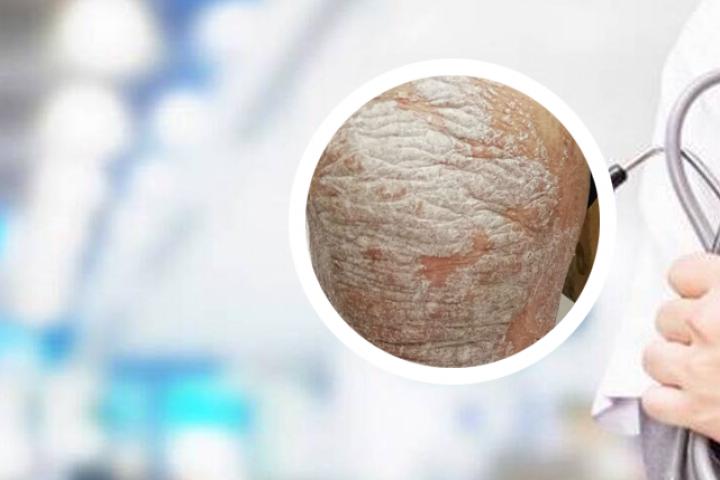 银屑病能吃白菜吗