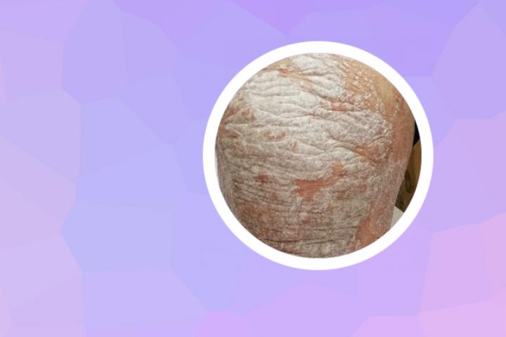 寻常型牛皮癣斑块型图片