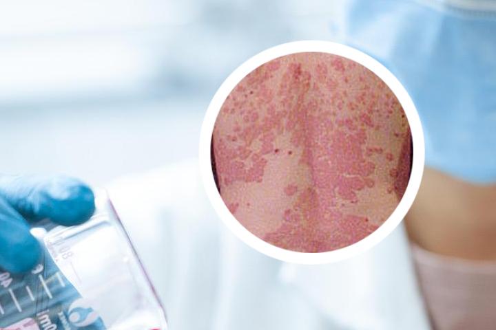 生物制剂治疗银屑病
