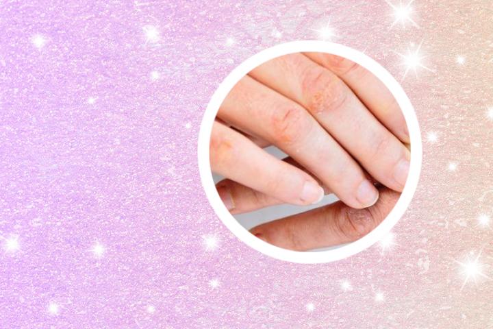 氨肽素治疗银屑病怎样
