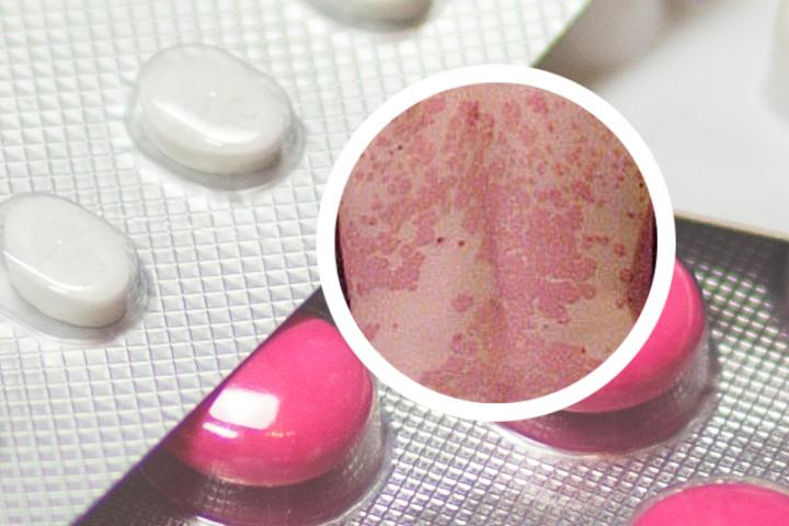 女性银屑病的治疗方法