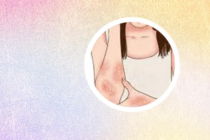蚌埠银屑病医院排名