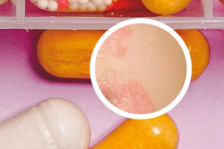 银屑病关节炎诊疗指南