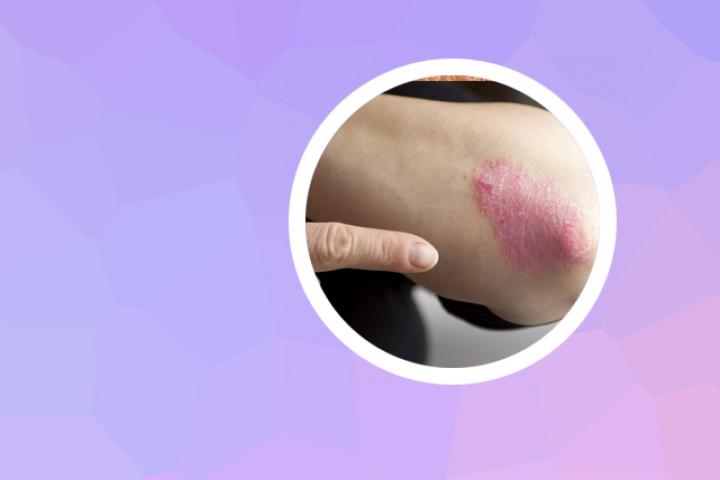 黑光灯治银屑病有效吗