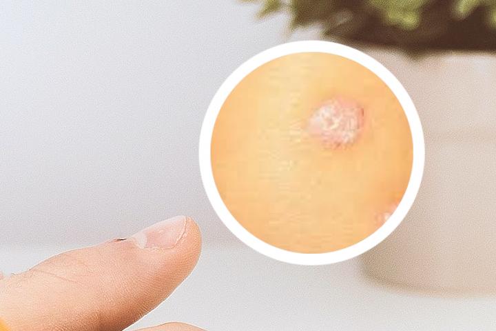 银屑病腿疼