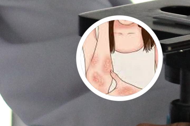 治疗牛皮癣疗效好的外用药