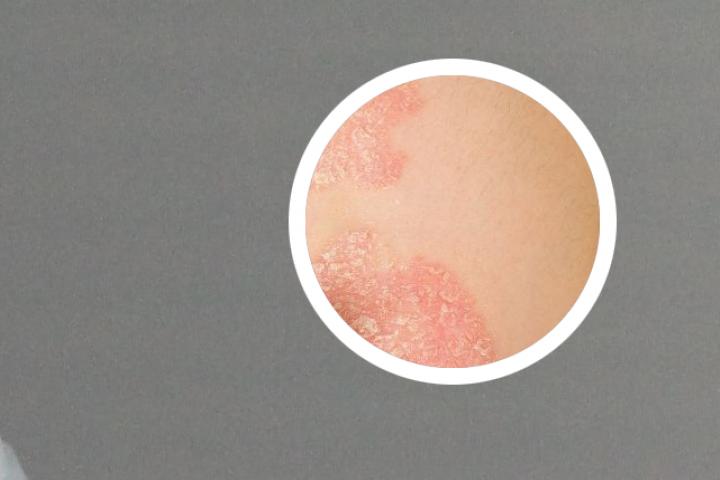黄连治疗银屑病吗