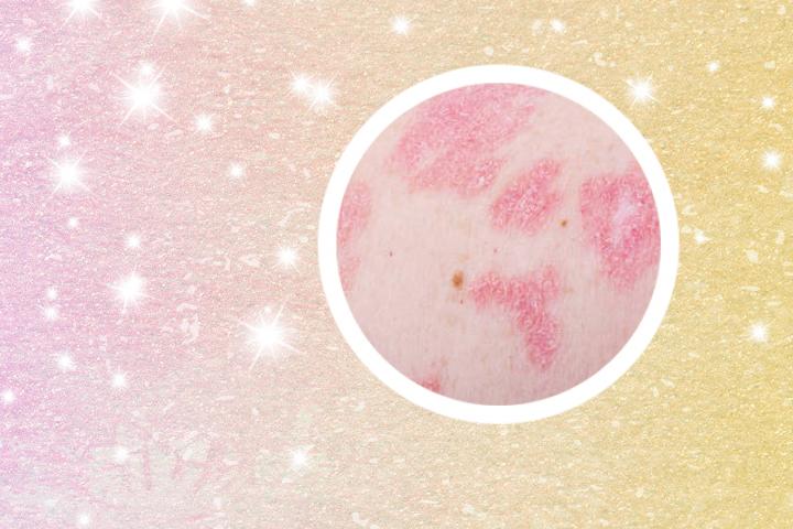 银屑病女生能否当兵