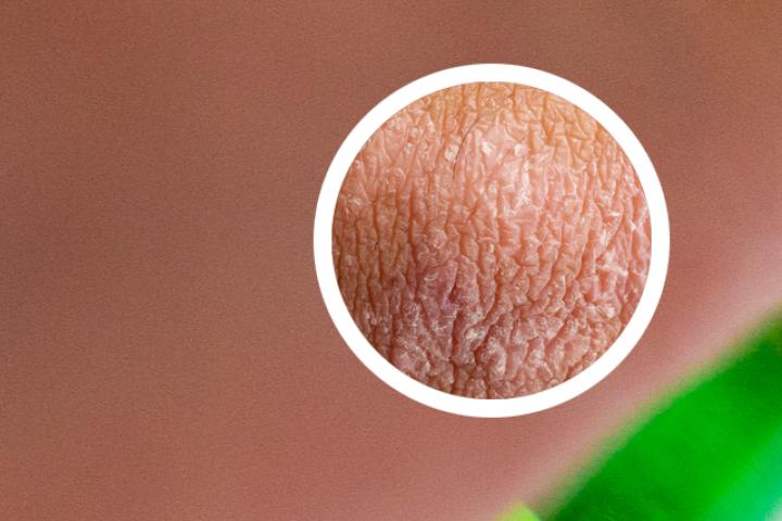 6A量子T细胞治银屑病