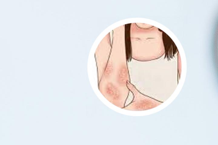 急性银屑病与银屑病区别